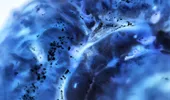 Cancerul pancreatic ar putea fi depistat cu până la 5 ani înainte. Cum ar putea ajuta inteligența artificială