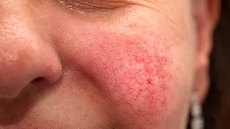 Semnul de pe față care îți arată că stai prost cu inima