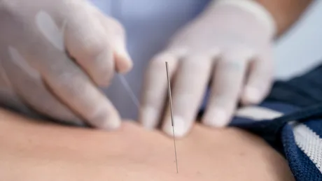 Specialiștii confirmă: acupunctura îmbunătățește libidoul și stimulează sănătatea sexuală