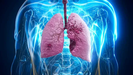 Mituri medicale despre cancerul pulmonar: ce este adevărat și ce nu