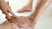 ​Picioare umflate, urină spumoasă și oboseală persistentă? Semne care pot indica probleme renale la persoanele cu diabet sau hipertensiune