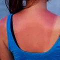 Arsurile solare nu sunt inofensive. Cinci episoade pot crește semnificativ riscul de cancer de piele