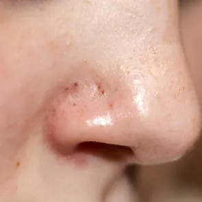 Tratamentul natural de 7 lei împotriva punctelor negre. Scapi de imperfecțiuni cu acest exfoliant preparat acasă