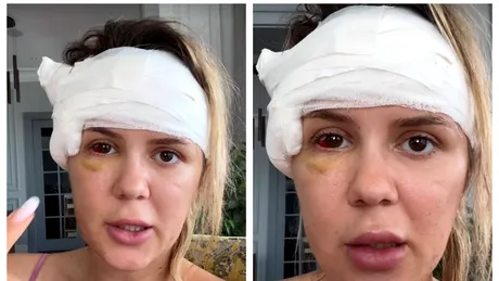 Emily Burghelea, vești triste din partea medicilor. Ce i se întâmplă după operație: „Abia după ce o să dea jos tija...”