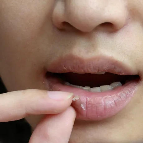 Cum tratezi natural buzele uscate și crăpate. Remedii naturale care vindecă buzele iarna