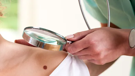 Cum se îndepărtează aluniţele: sfatul dermatologului