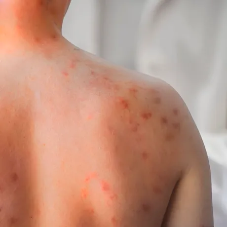 Descoperire majoră în lupta împotriva rujeolei. Cercetătorii au găsit anticorpi capabili să prevină și să trateze infecția