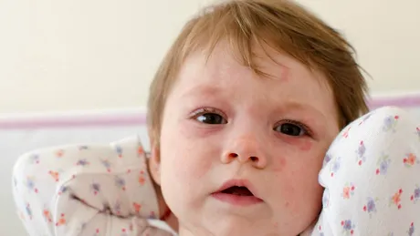 Rubeola: simptome, tratament