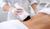 (P) Liposucția nechirurgicală Liposonix – cum funcționează și pentru cine este potrivită