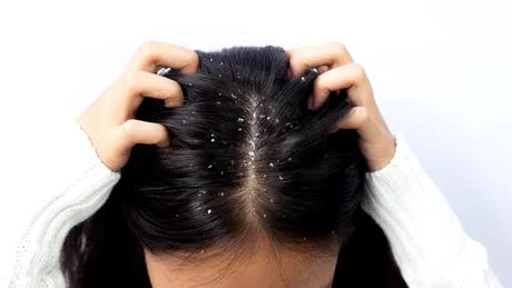 Cum să scapi de mătreață pentru totdeauna. Obiceiul sănătos pentru scalp