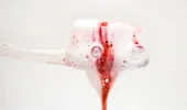 Ce boală poate ascunde sângerarea gingivală? Explică dr. Cosmin Dima