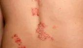 Remedii naturale care pot ajuta în psoriazis. Ce metode au fost studiate și ce trebuie evitat?