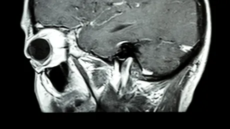 Mărturisirea unei neurocercetătoare, supravieţuitoare a cancerului cerebral