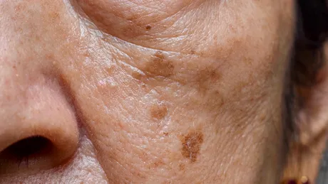 20 de semne care apar pe piele când ai ficatul bolnav