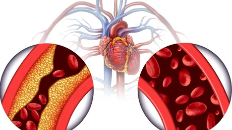 Hipercolesterolemie familială: cauze, simptome, tratament