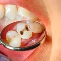 Știai că există mai multe tipuri de carii dentare și că cele negre nu sunt cele mai periculoase?