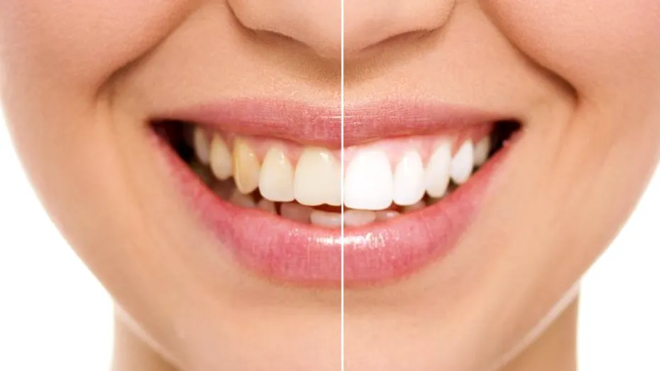 5 metode de albire a dinţilor