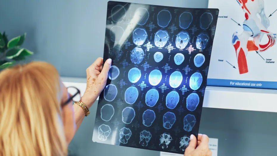 Avertisment pentru pacienții cu demență! Medicamentul care crește riscul de AVC