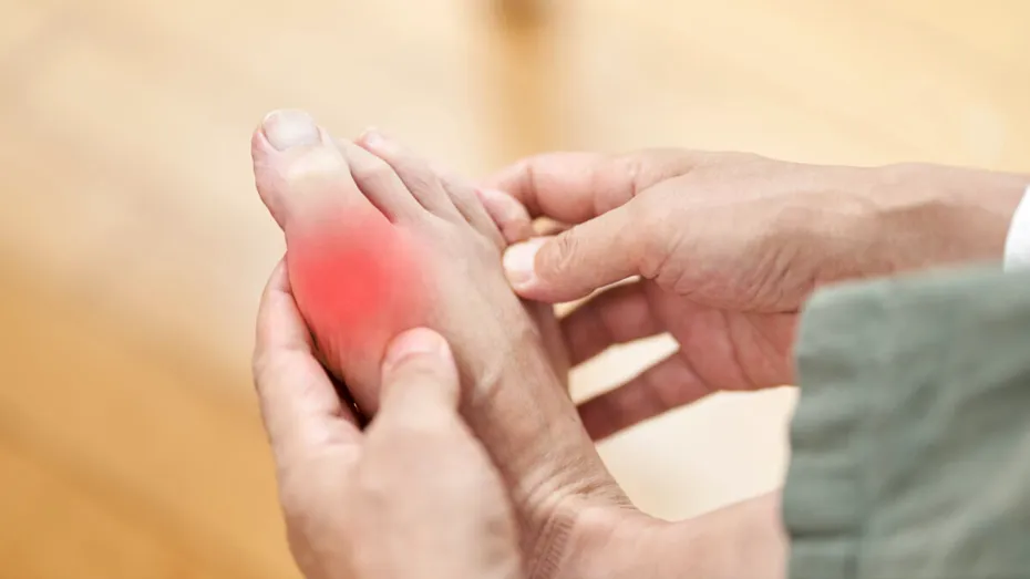 Cum să ții sub control nivelul ridicat de acid uric — fără medicamente