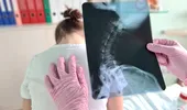 Cele 4 semne vizibile care pot indica scolioza la copii. Afecțiunea apare frecvent între 10 și 15 ani