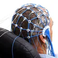 Semnul din timpul somnului asociat cu demența și Parkinson. Poate apărea cu ani înaintea diagnosticului