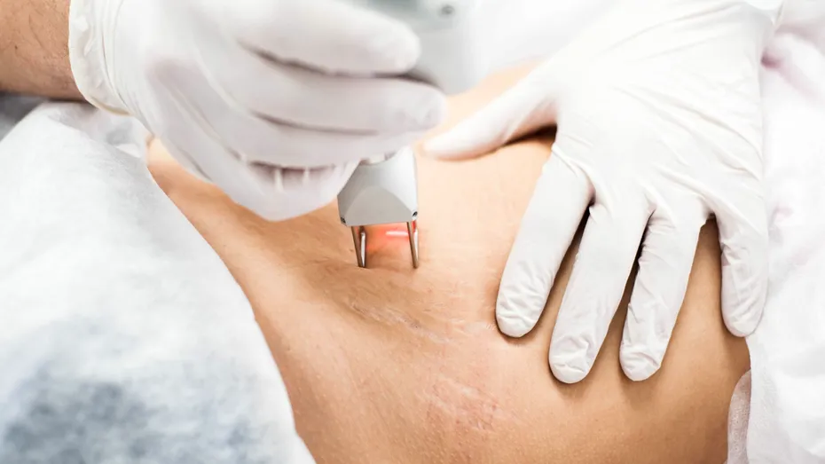 Cele mai noi și mai eficiente tratamente pentru cicatrici și vergeturi