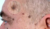 Doar 2 din 10 persoane recunosc semnele melanomului, cea mai agresivă formă de cancer de piele. Cum îl depistezi rapid