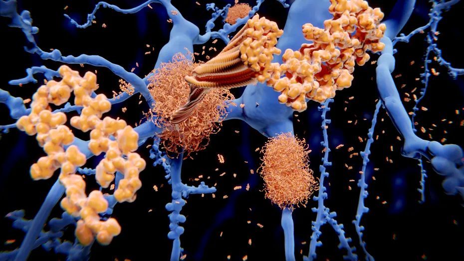 Dovedit științific: colesterolul crescut, una dintre cauzele demenței