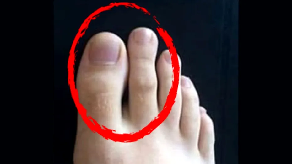 Ai al doilea deget al piciorului mai lung decât degetul mare? Este sau nu o anomalie?