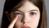 Ochi umflați din cauza alergiilor: cum să previi și să tratezi