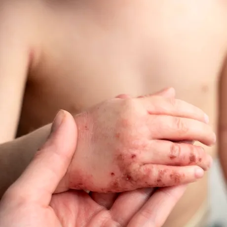 Piodermita: Cum recunoști „infecția ascunsă a pielii” și cum o tratezi rapid