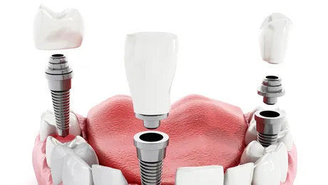 Implantul dentar: ce trebuie să faci în primele zile după operaţie