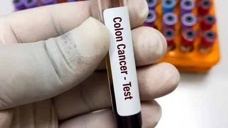 Testul de sânge gratuit care ajută la descoperirea cancerului de colon în stadiu incipient