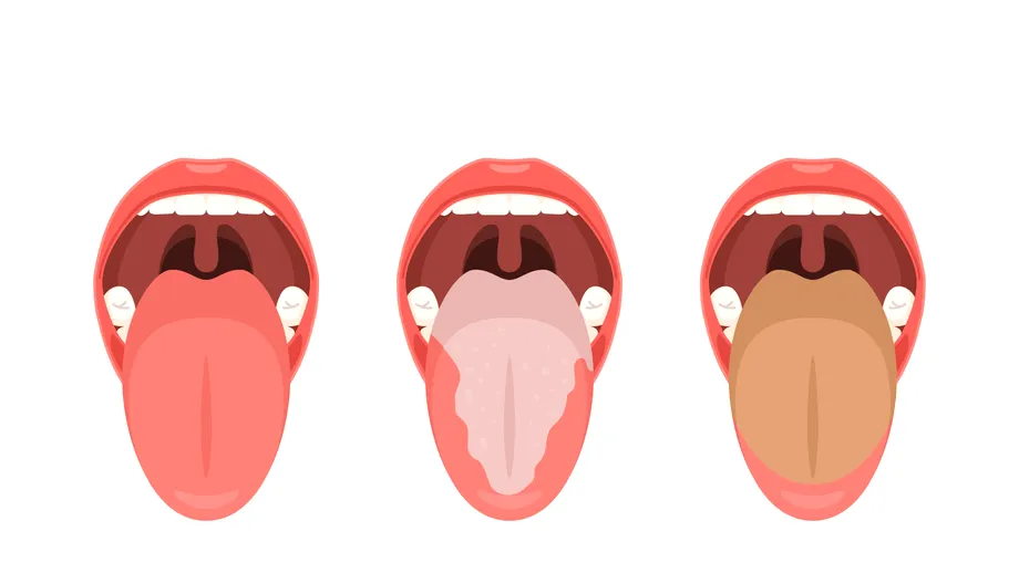 Ce spune limba despre sănătatea ta. Boli pe care le depistezi în oglindă