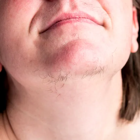 De ce apar fire de păr pe barbă la femei. 10 cauze medicale