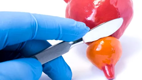 Adenom prostatic: cauze, simptome, tratament