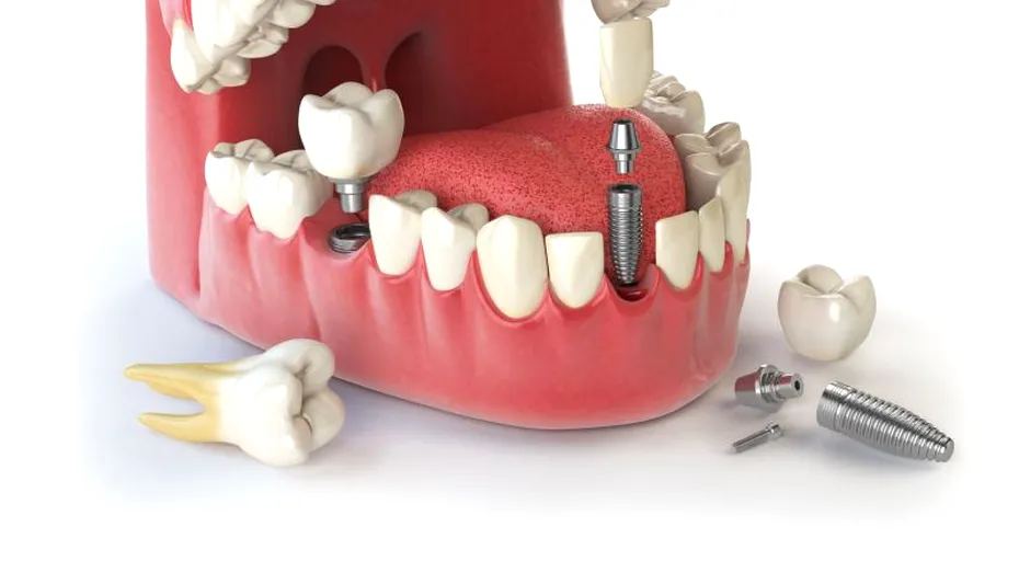 Implanturi dentare: avantaje şi dezavantaje, indicaţii şi contraindicaţii