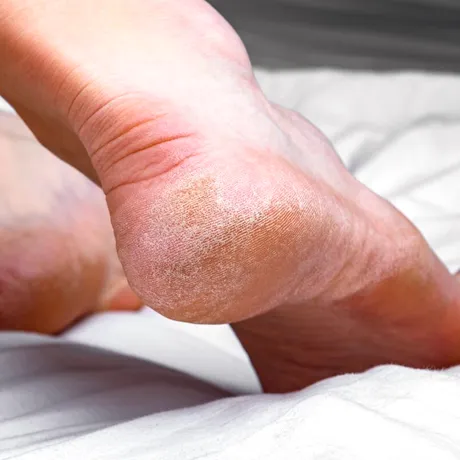 Călcâie crăpate și uscate? Trucul simplu recomandat de Dr. Adina Alberts