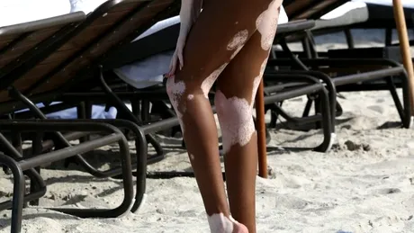 Winnie Harlow, în costum de baie. Cum arată în bikini cel mai sexy model cu vitiligo