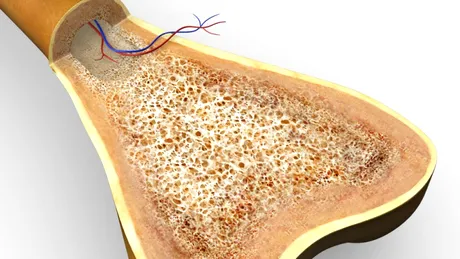 Osteomielita: cauze, simptome, tratament