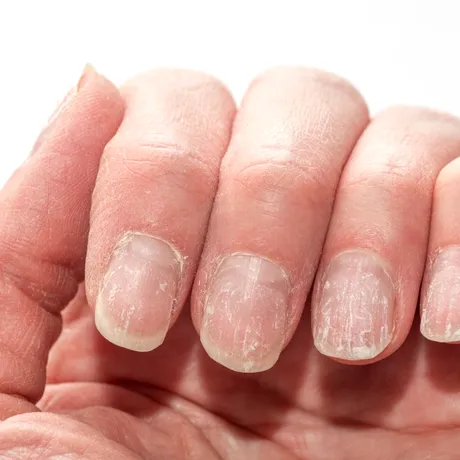 Unghiile pot semnala boli grave. Semnul discret care poate indica probleme ale inimii, ficatului sau rinichilor