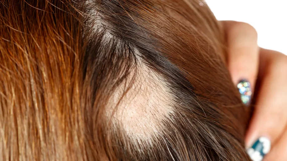 3 coafuri care cauzează alopecia de tracțiune. Nu-ți mai prinde părul AȘA!