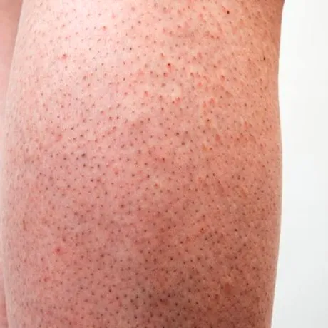 Strawberry legs – 3 cauze și tratament pentru piele „de căpșună” pe picioare
