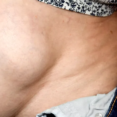 Nu amâna operația de hernie! Se poate ajunge la ocluzie intestinală, care pune viața în pericol