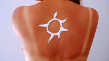 6 remedii împotriva arsurilor solare care funcționează mai bine decât aloe vera