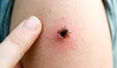 Cum să te ferești de mușcăturile și înțepăturile de insecte: țânțari, căpușe sau păianjeni