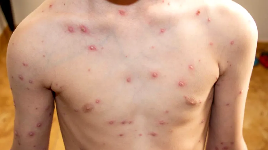 Rujeola, mai aproape de un tratament? Cercetătorii au identificat anticorpi care neutralizează virusul