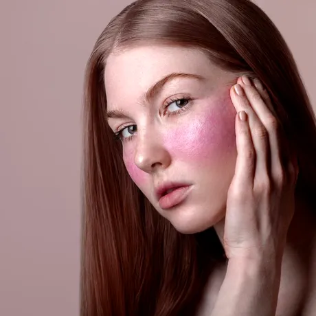 Rozaceea: cum se tratează corect și ce tehnologii moderne fac diferența