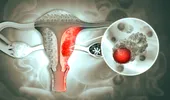Peste 40% dintre femeile cu cancer ovarian află diagnosticul abia după o urgență medicală. Simptome pe care nu trebuie să le ignori, de la balonare persistentă, la urinări frecvente