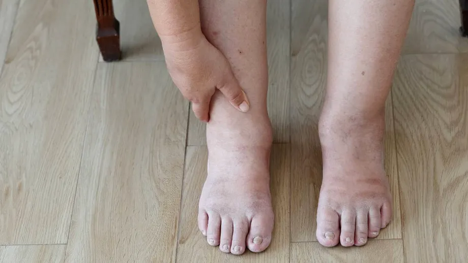 Ai mâini și picioare umflate vara? Boala care stă în spatele acestui simptom